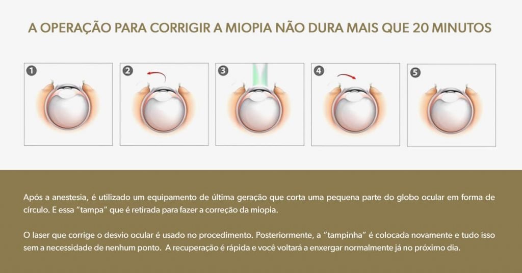 Operação para corrigir miopia